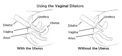 How to Use Vaginal Dilators